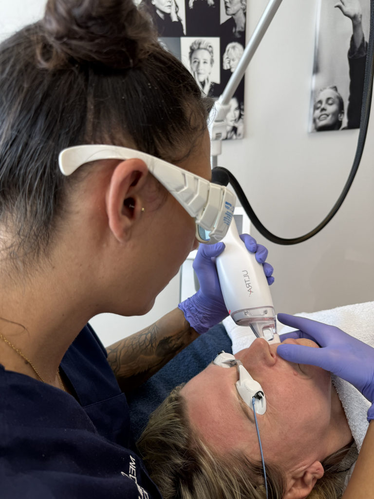 Im Vordergrund eine Dame mit einer Schutzbrille, welche eine Thulium-Laser-Behandlung bei einer liegenden Dame im Gesicht durchführt
