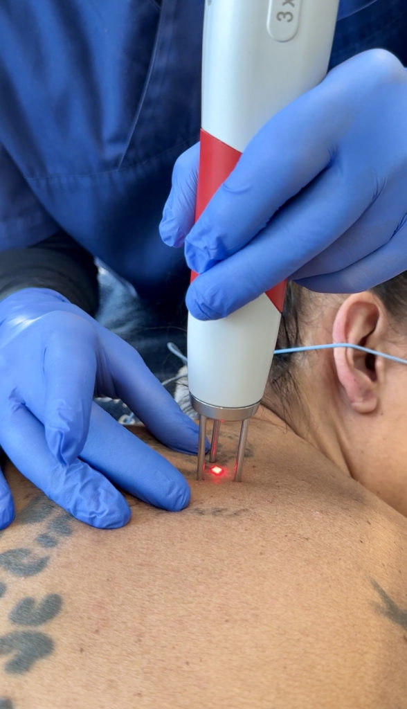 Nahaufnahme des Lasergerätes, während das Tattoo mit Laser behandelt wird.